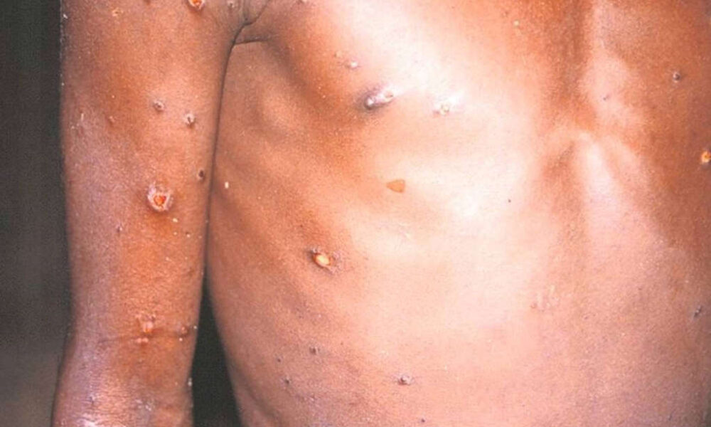 Aumentan a tres los casos de viruela del mono en República Dominicana