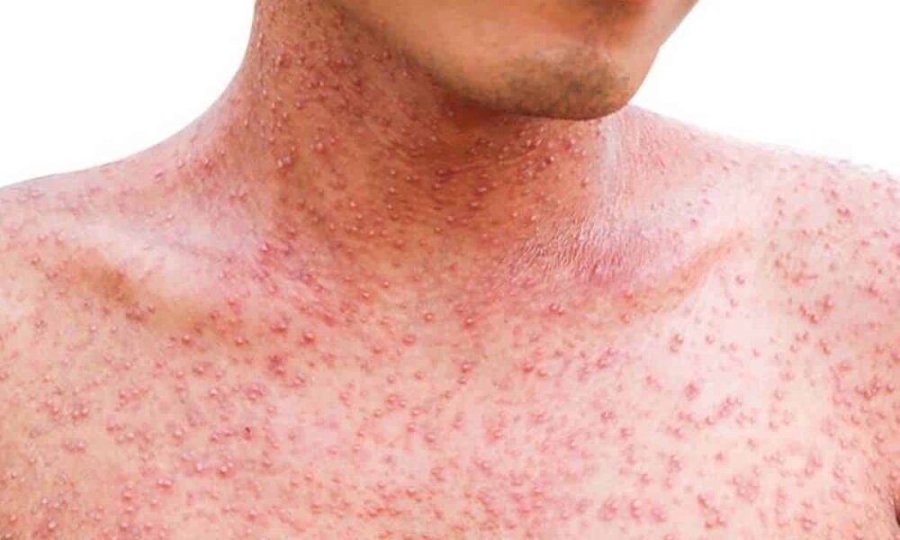 Alerta epidemiológica en República Dominicana ante el riesgo de sarampión
